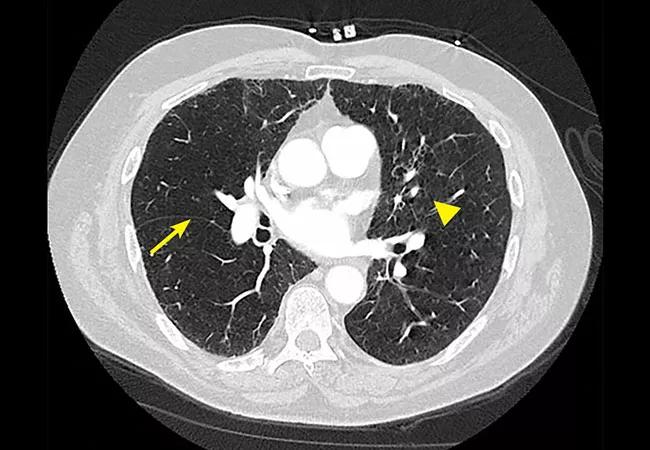 650&#215;450-20-PUL-1940073-CQD&#8212;Bronchoscopic-lung-volume-reduction