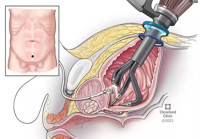 R-Port Laparoscopic Trans BladderProstatectomy