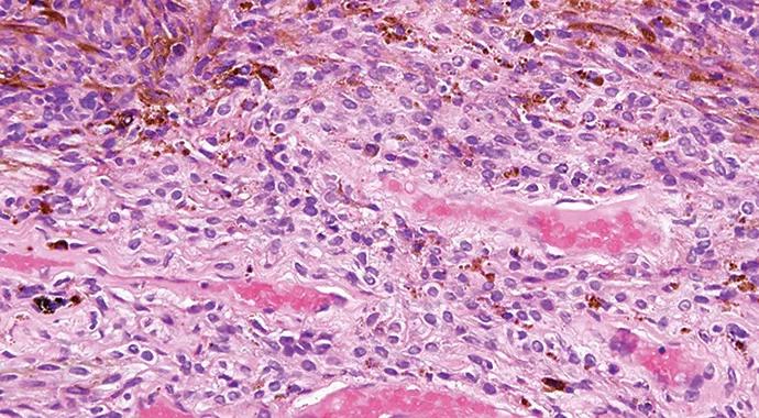 690&#215;380-Eye-Tumor