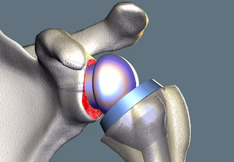 Illustration of Reversed shoulder replacement