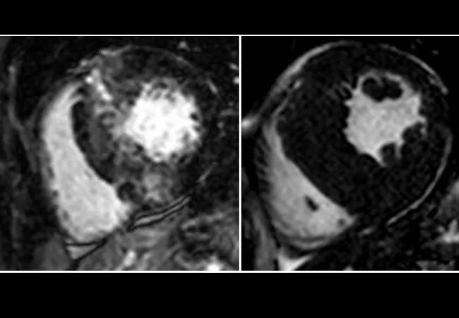 cardiac magnetic resonance images showing hypertrophic cardiomyopathy