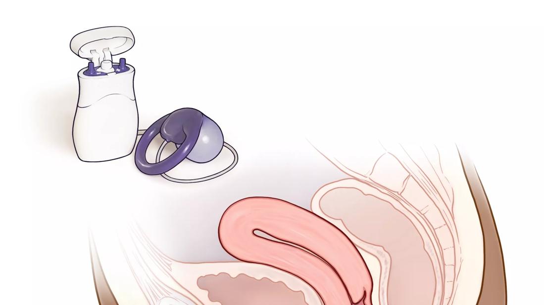 Vaginal Insert Offers Relief from Fecal Incontinence