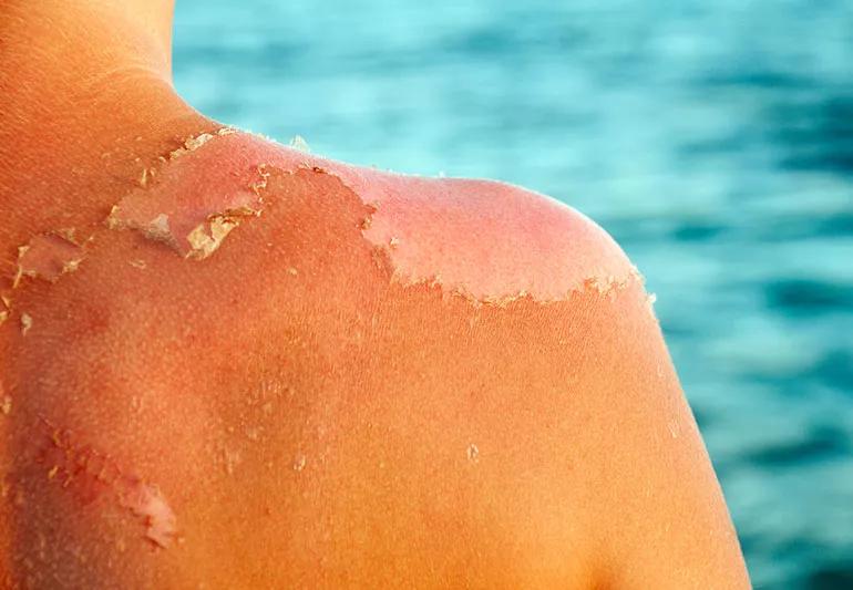Close-up shot of sunburnt skin, peeling on the shoulder to expose raw skin.