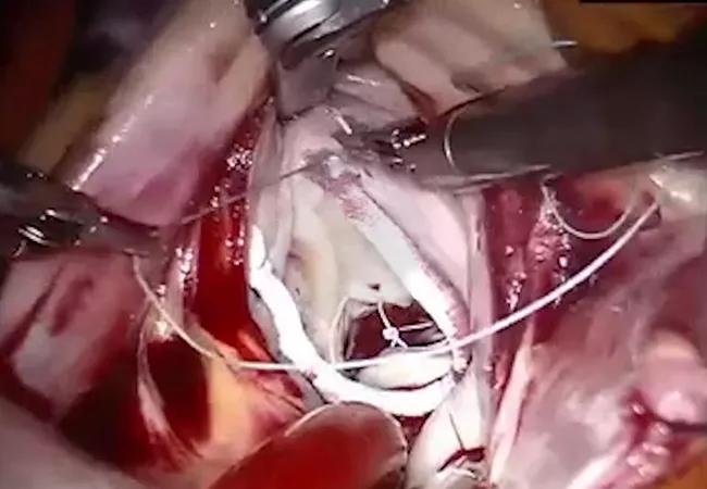 22-HVI-3294758_robotic-mitral-valve-surgery_650x450