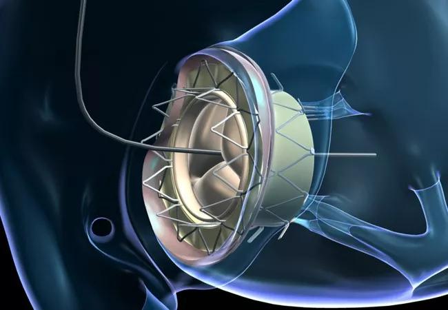 18-HRT-4694-Transcatheter tricuspid valve-650&#215;450