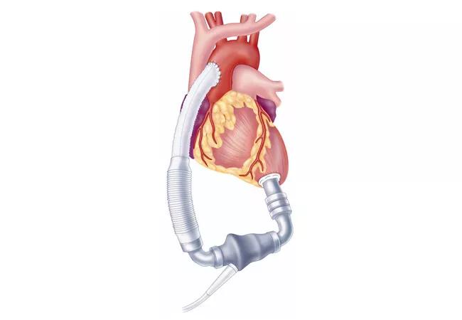 An illustration of the exact type of LVAD at the center of this ROADMAP study