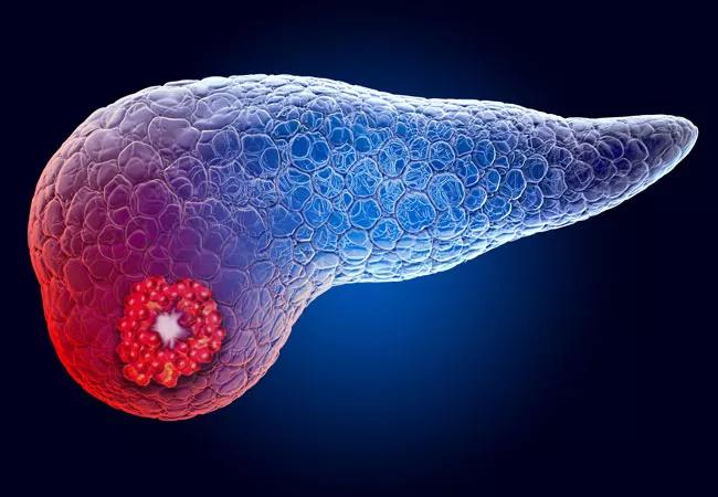 20-DDI-1892011-CQD-Pancreatic-Cysts