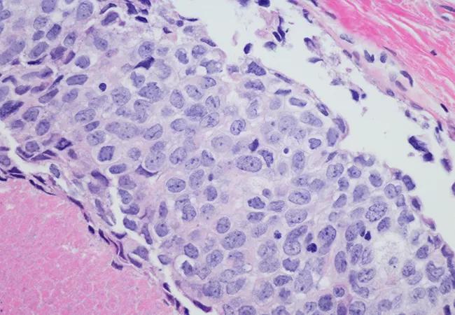 Ductal carcinoma (breast cancer) high grade.
