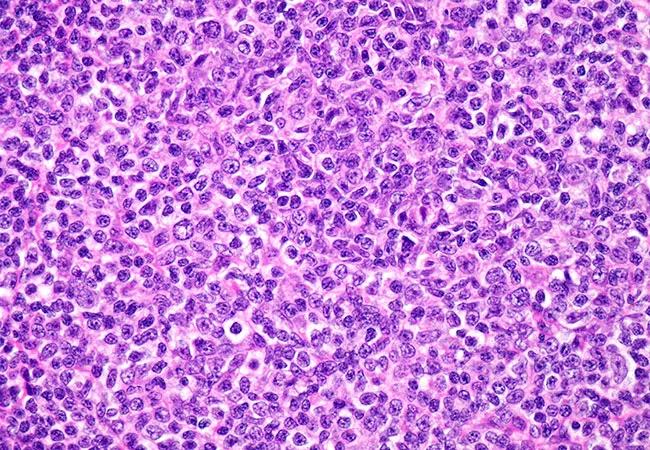 QD-Follicular-Lymphoma-WINTER