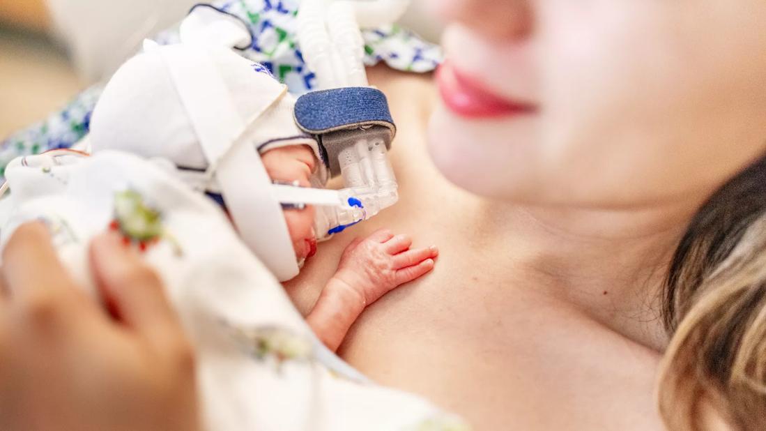 650&#215;450-Nasal-Injuries-NICU-babies