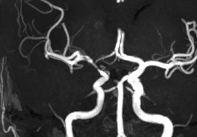 Imaging of vessels in CNS vasculitis