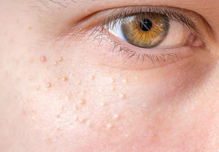 Pimples around eye on skin