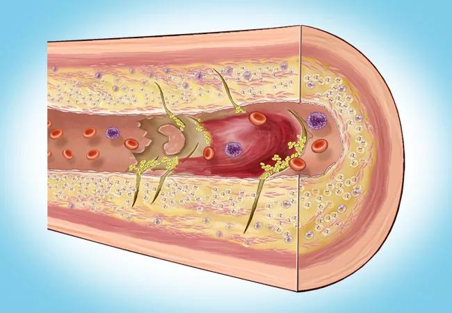 23-HVI-3606661_atherosclerosis_650x450