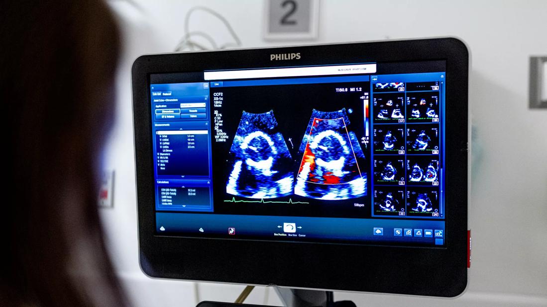 Echocardiogram
