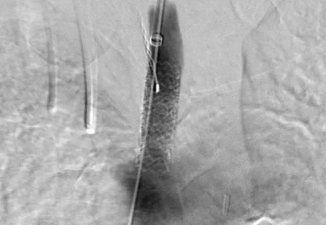 20-HVI-1868665-carotid-artery-stenting