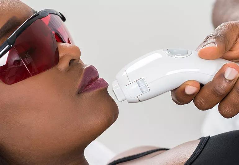 woman receiving laser hair removal on chin