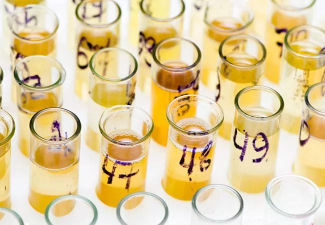 650&#215;450-Urine-Samples-GettyImages-92192499_New Header_16-URL-856