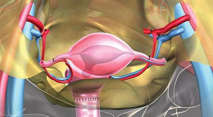 Uterine-Transplant-690&#215;380