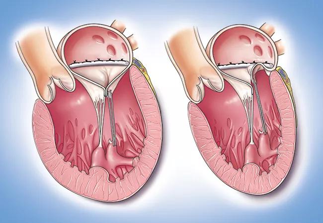 illustrations of chambers of the human heart