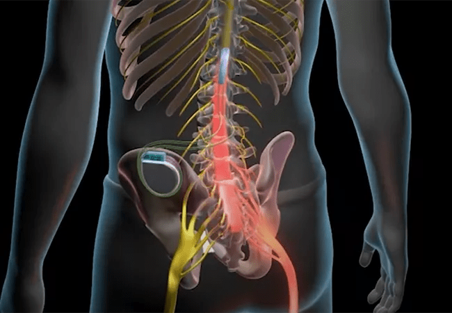 Neuromodulation