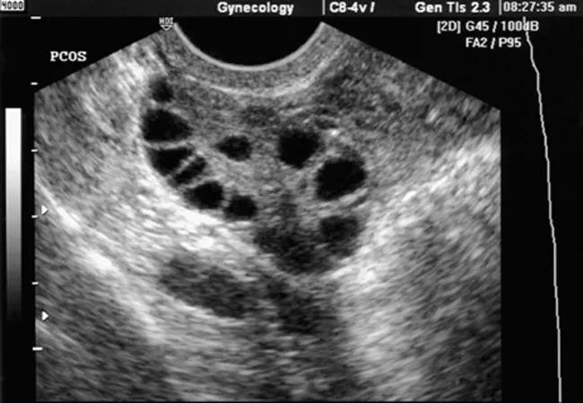 18-OBG-037_PCOS