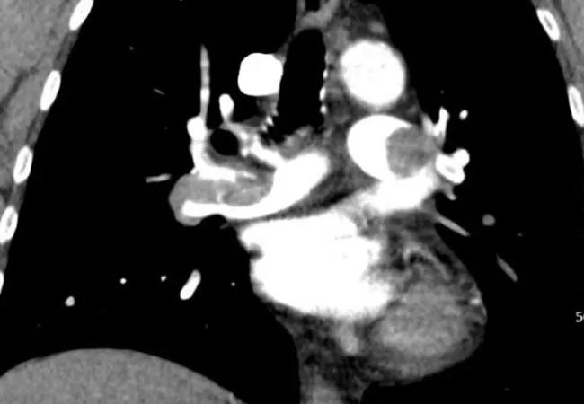 pulmonary embolism