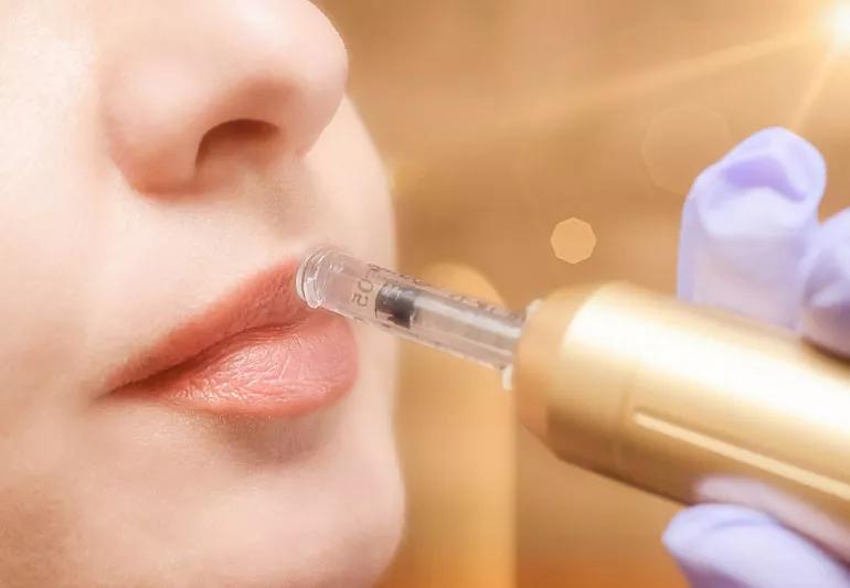 Closeup of person receiving hyaluron pen lip filler treatment.