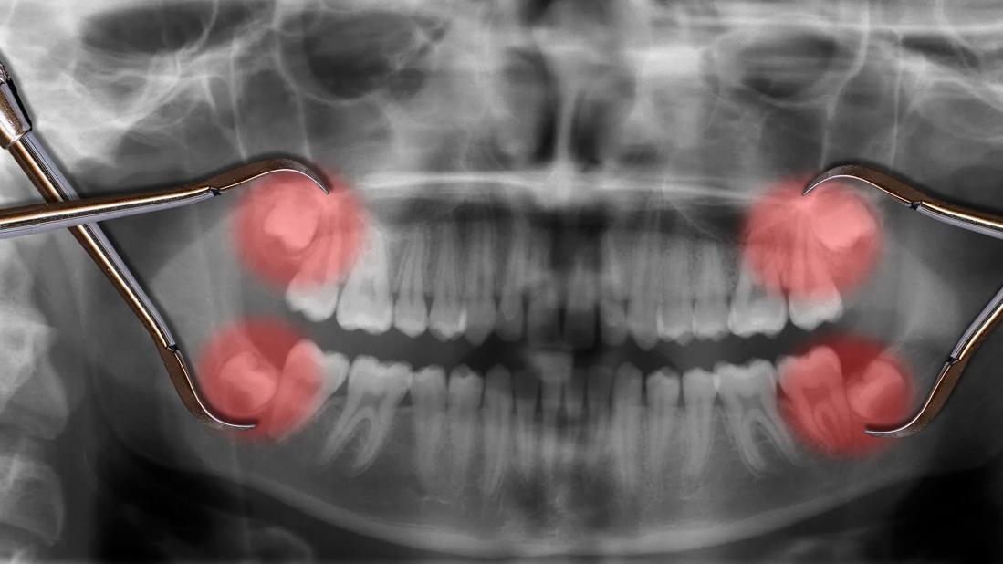 X-ray of teeth, with wisom teeth highlighted red, with dental tools on top of X-ray