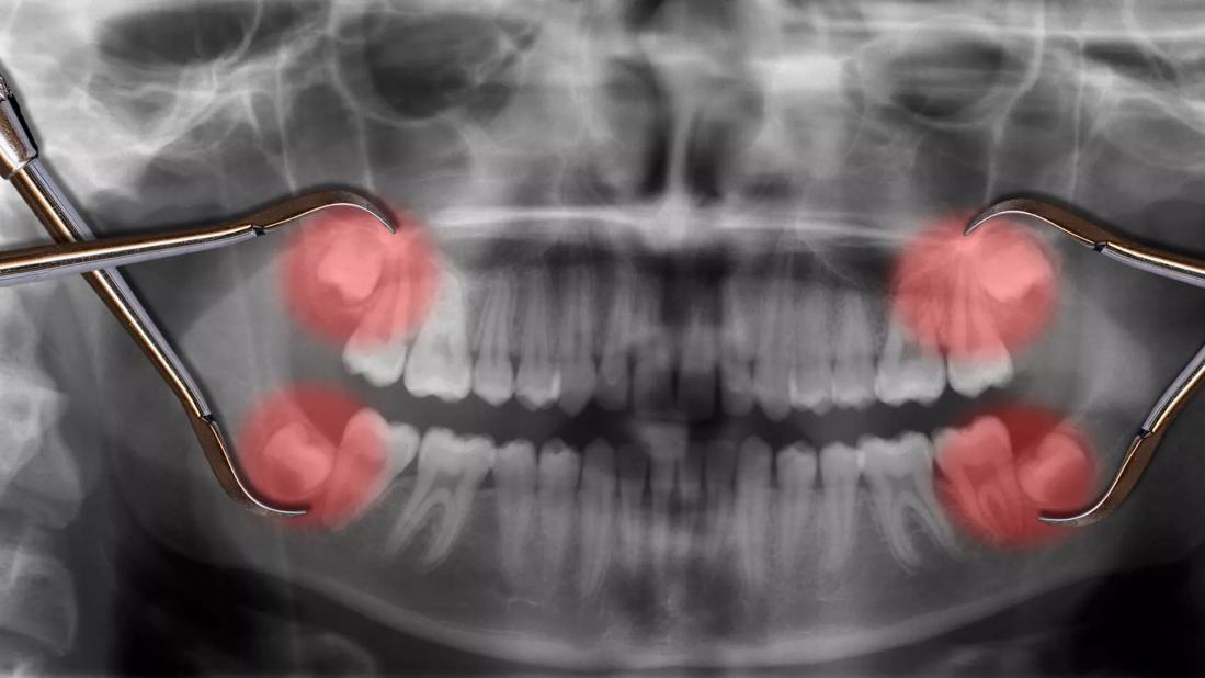 Do You Have to Remove Your Wisdom Teeth? Tips for Care