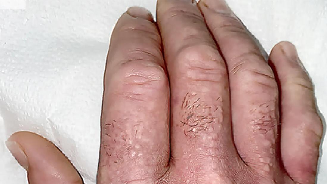 waxy papules on his hands, with associated skin thickening and finger flexion contractures on hand