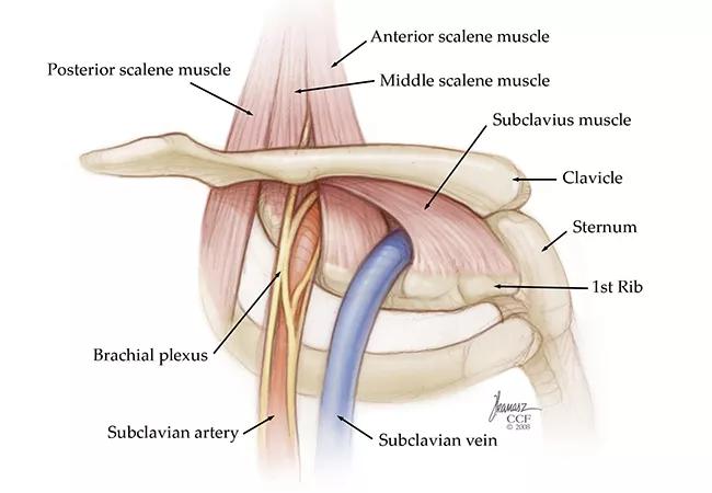 thoracic outlet syndrome illustration
