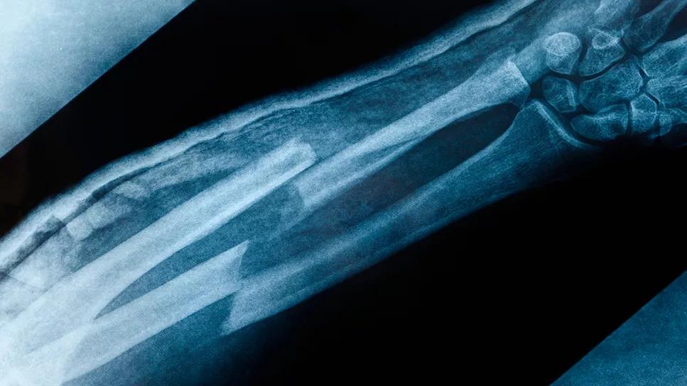 x-ray of bone fracture in a forearm