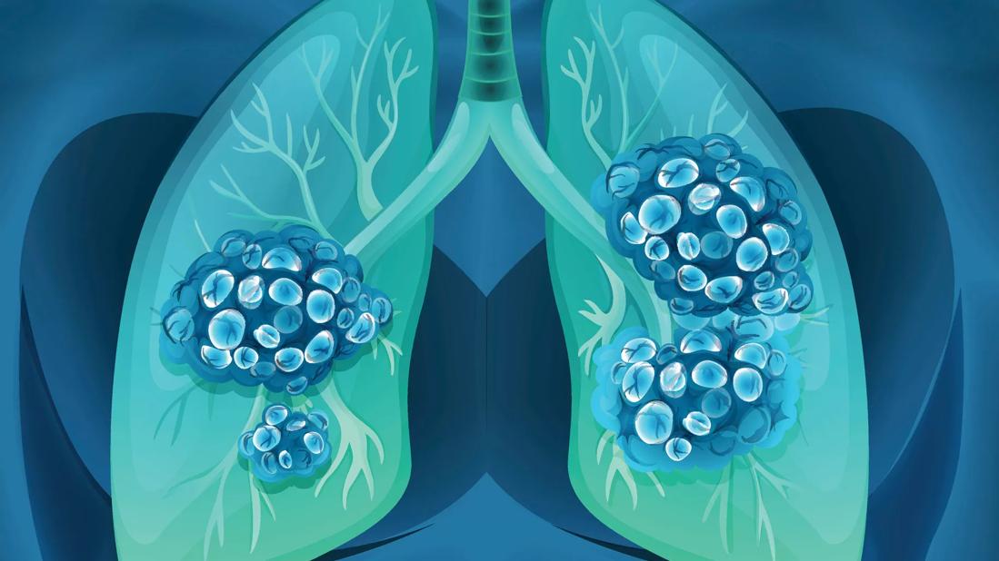 Lung Cancer Screening
