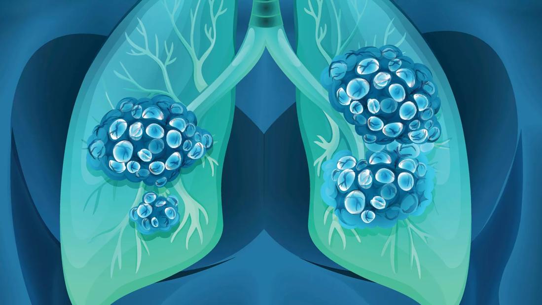 What Are the Chances a Lung Nodule or Spot Is Cancer?