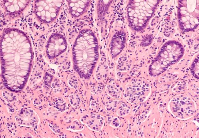 Neuroendocrine tumor micrograph