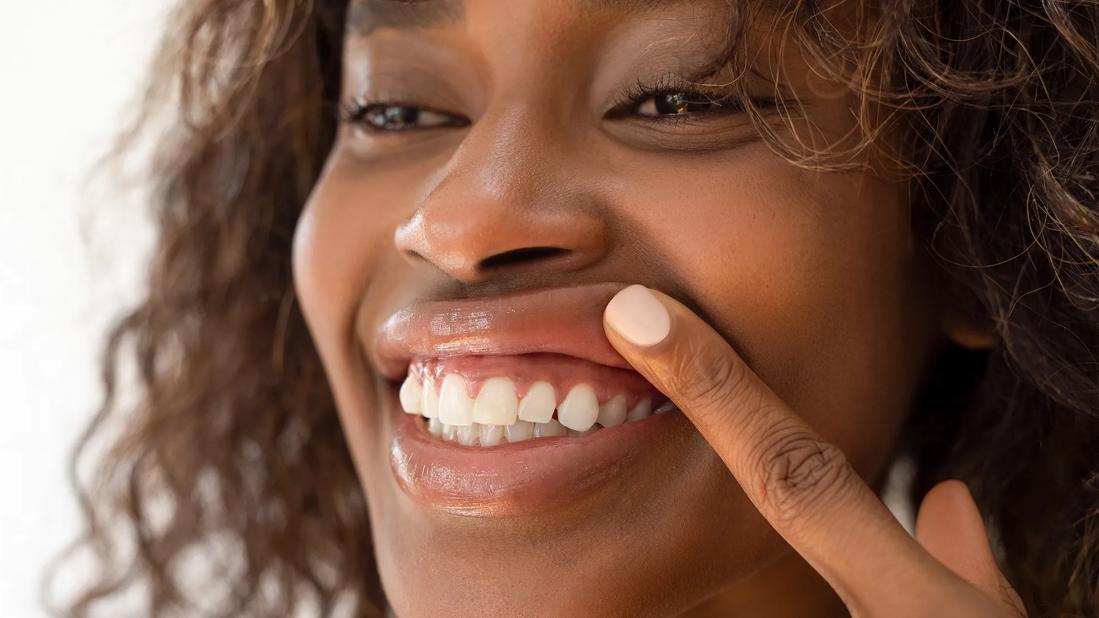 Person lifting up lift to show teeth and gums