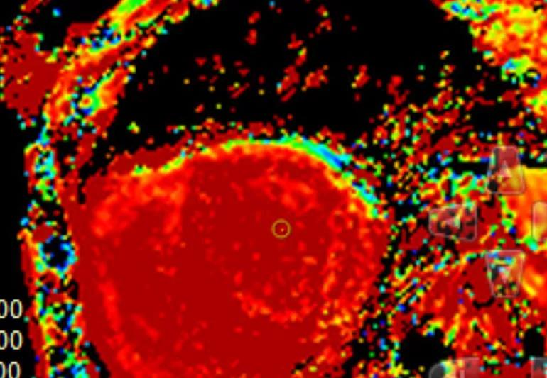 Closeup slide of amyloidosis