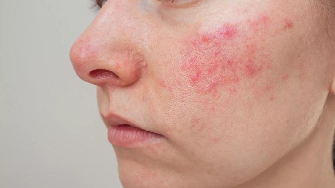 Close up of face with rosacea on cheeks