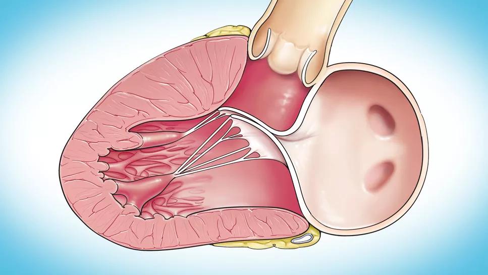 hypertrophied human heart