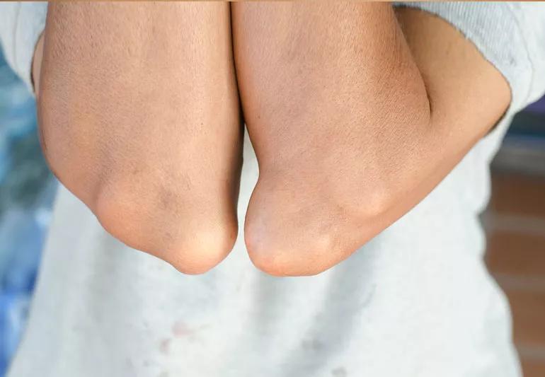 woman with elbows affected by gout