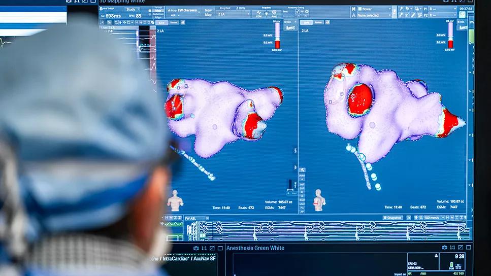 photo of an ablation procedure in an electrophysiology lab