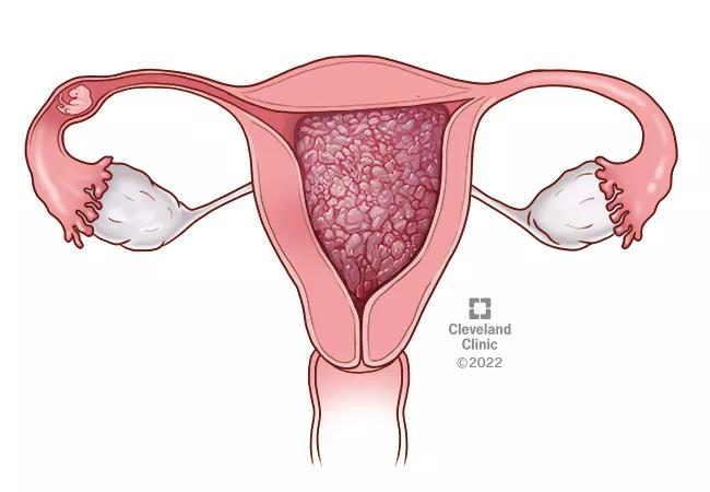 molar pregnancy