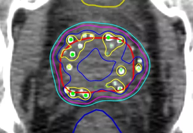 650&#215;450-Prostate-Cancer