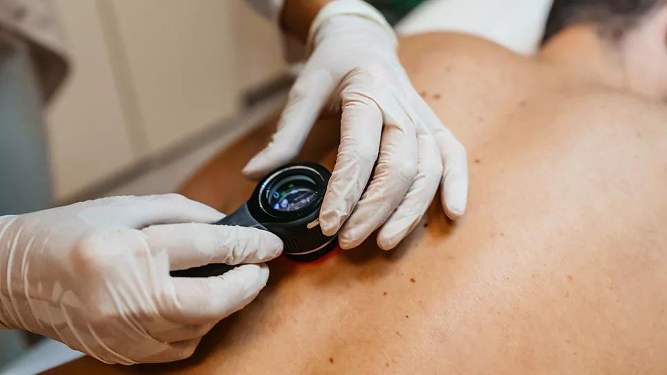 Gloved hands of healthcare provider examining moles on a back