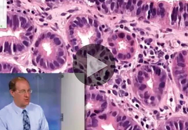 Issues with Esophageal Biopsies: A Focus on Barrett’s Esophagus (Video)