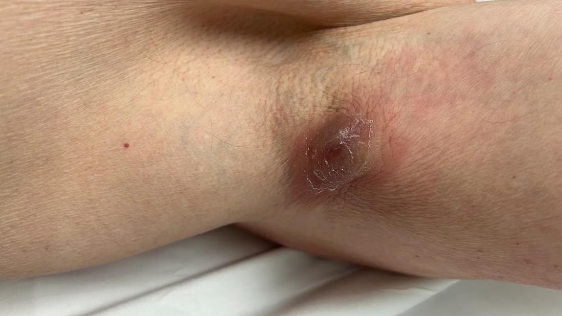 An open wound in a patient's armpit