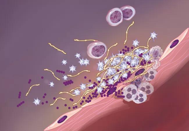 Illustration of infective endocarditis