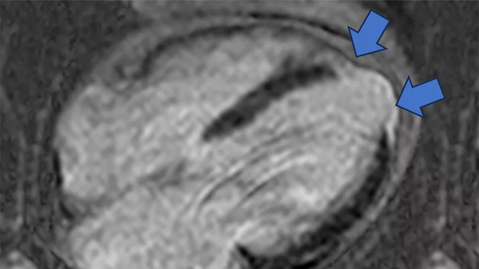 cardiac magnetic resonance image