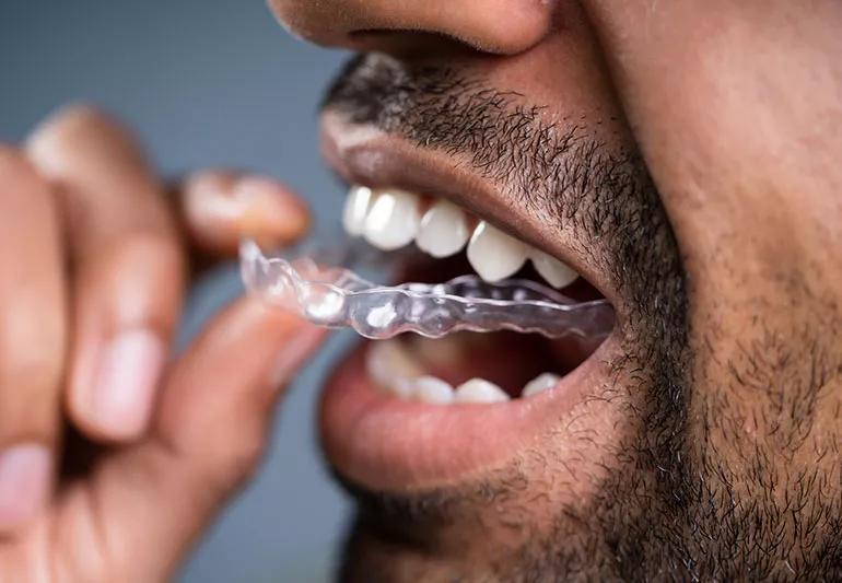 Closeup of person pulling a clear mouthguard out of their mouth