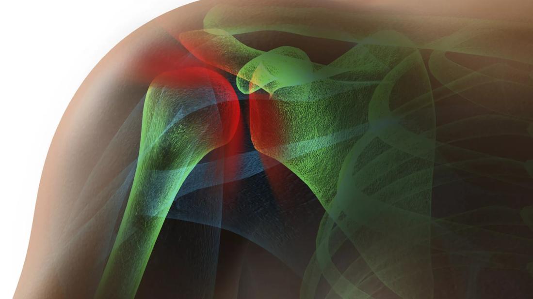 Rotator cuff